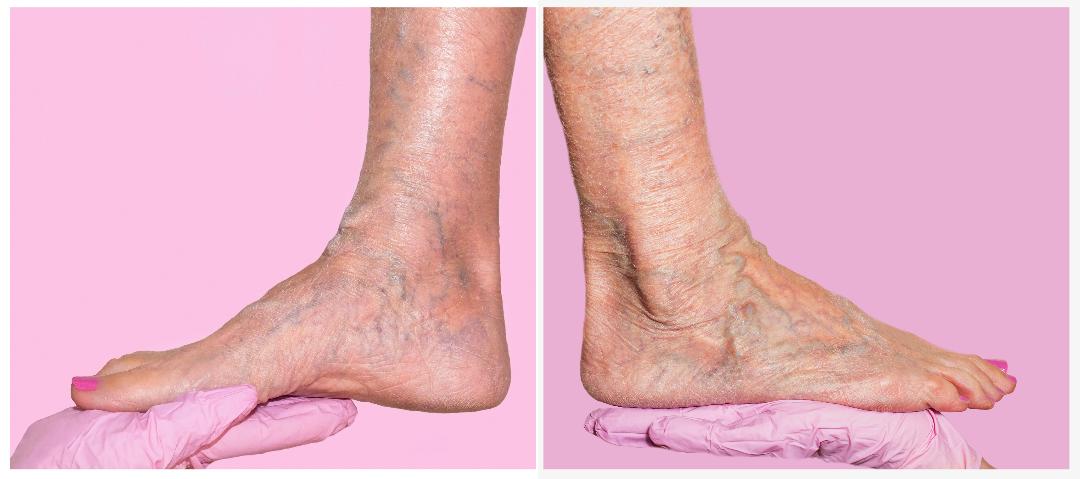 insuficiență venoasă cronică-picioare cu varice