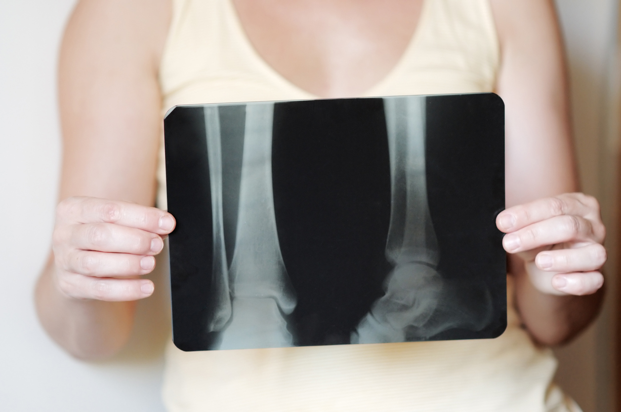 Femeie care ține o radiografie în mână