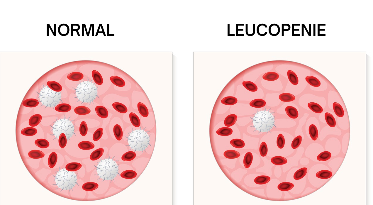 Ilustrație ce prezintă ce înseamnă leucopenia