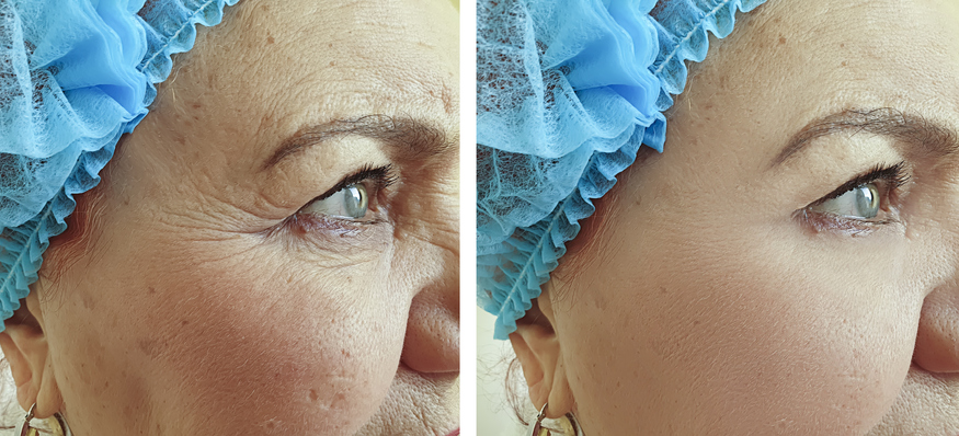 Femeie care și-a făcut tratament facial cu laser