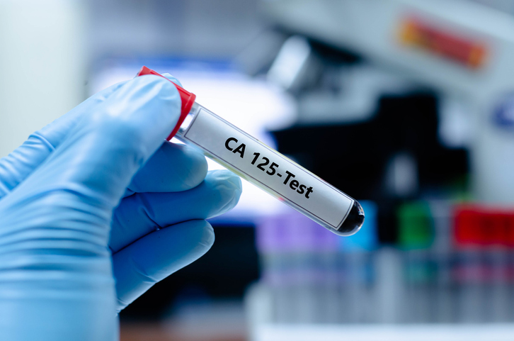Eprubeta cu sânge pe care scrie ca-125