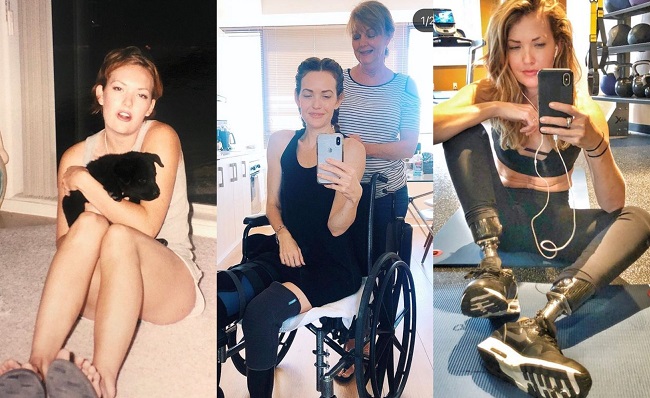 Amy Purdy în cele trei etape ale vieții: înainte să îi fie amputate picioarele, în perioada de vindecare, după refacere.