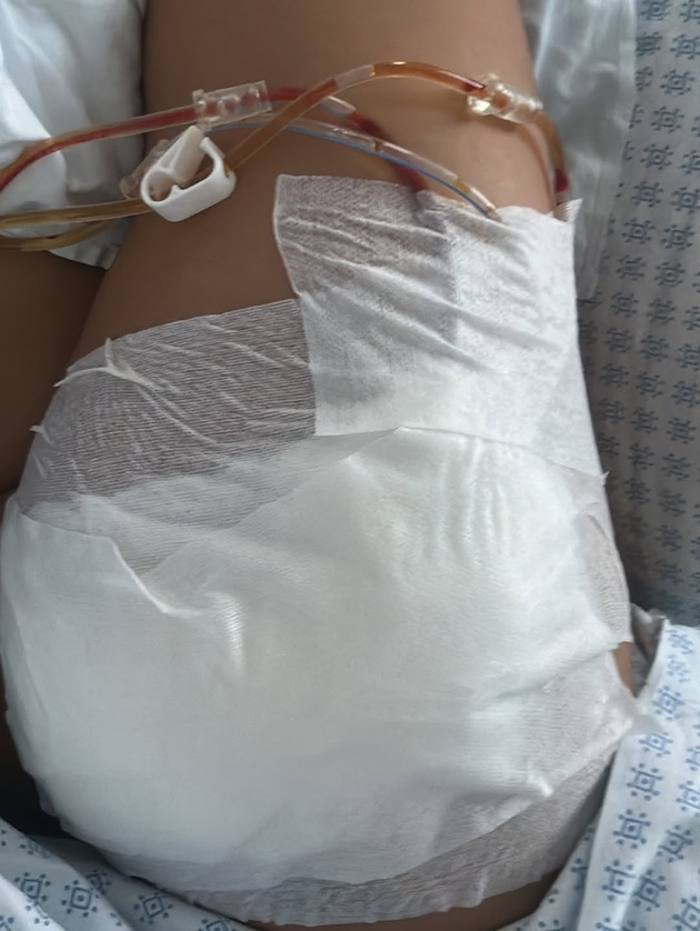 Fundul Antoniei Iacobescu bandajat după operație