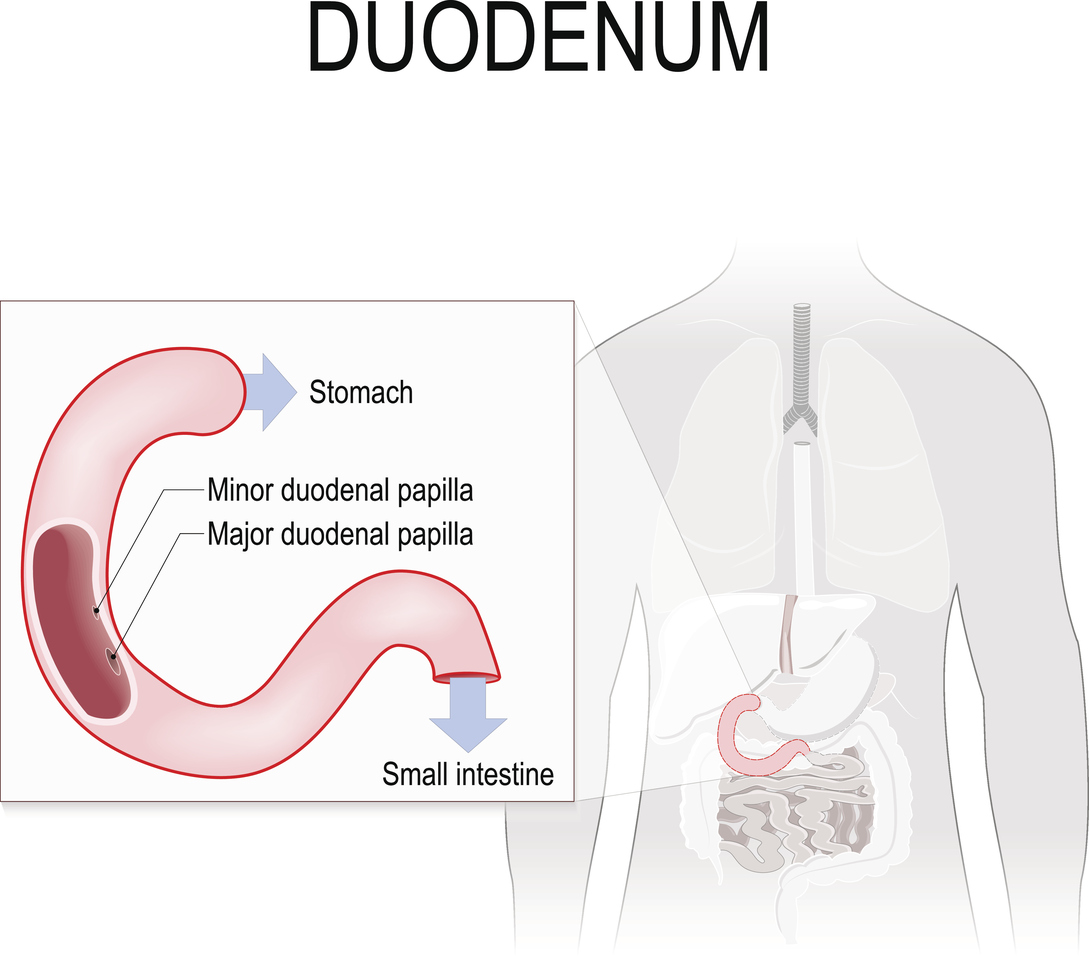 ulcer duodenal