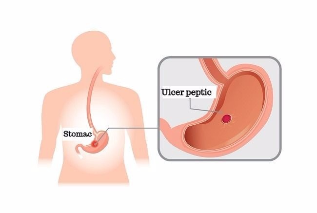 Rana pe stomac cauzata de ulcerul peptic