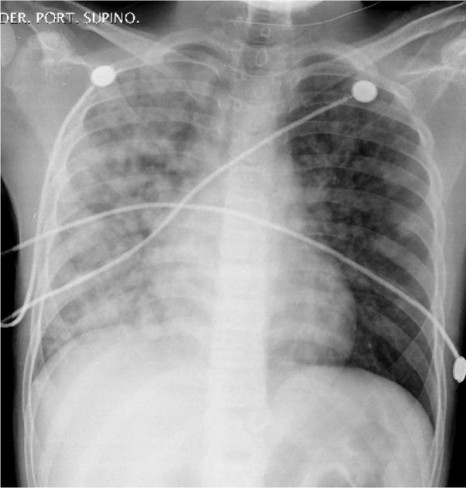 Radiografie edem pulmonar
