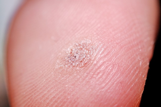 hpv virus and neck cancer pentru plamani