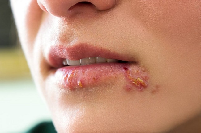 herpes bucal