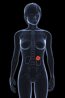 cancer renal