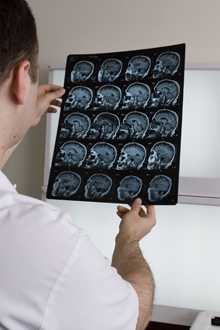 hematom subdural