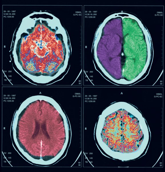 craniosinostoza