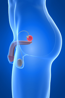 varicocelul