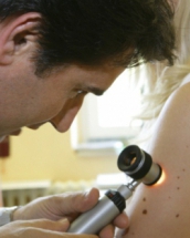 Cum se pune diagnosticul de melanom, cel mai agresiv cancer de piele adus de soare! 