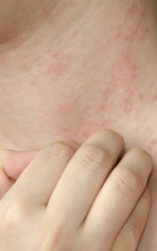 Alergia la frig: cauze, simptome, tratament