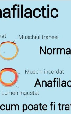 Socul anafilactic: Cauze, simptome si tratament