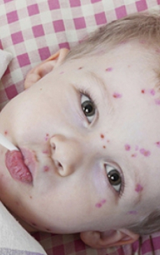 Cum sa tratezi varicela sau varsatul de vant la copii sau la adulti