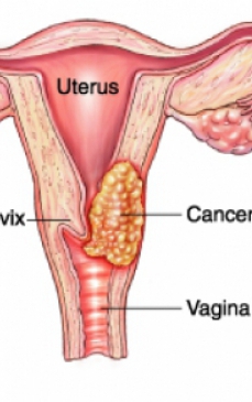 Cancerul de col uterin, mai frecvent in Romania, Bulgaria, Serbia si Lituania. Care sunt CAUZELE