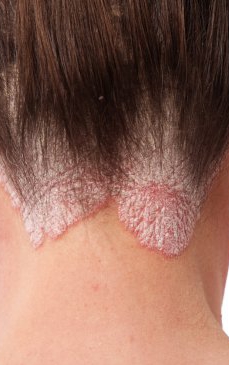 Psoriazis scalp