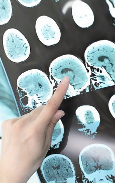 Obiceiul alimentar care crește riscul de accident vascular