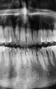 Cât de periculoase sunt radiografiile dentare