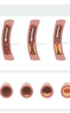 Artere înfundate: cauze, simptome și tratament
