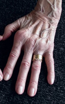 Artrita reumatoida - simptome, diagnostic si tratament