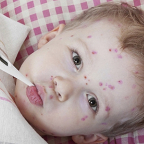 Varicela La Copii Varicela La Adulti