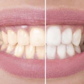 Albirea Dintilor Cu Bicarbonat Divahair Ro