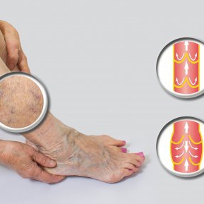 picioarele umflaturi în câmpurile varicoase nutriie pentru reete varicoase