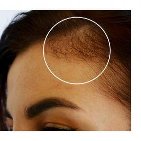 Ce să faci acum dacă pierzi neașteptat de mult păr