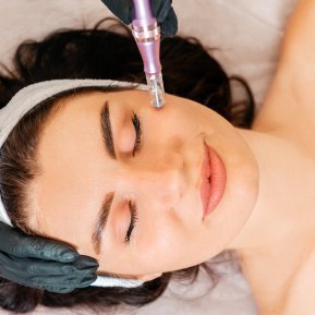 Microneedling: ce presupune și cum îți ajută pielea