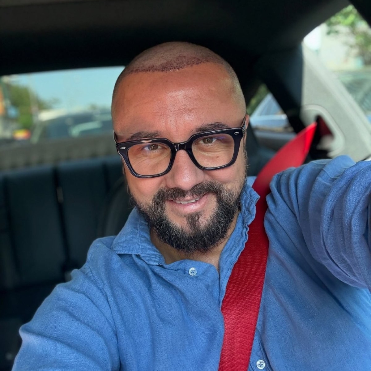 Cătălin Măruță și-a făcut din nou implant de păr. A vorbit fără perdea despre intervențiile făcute de-a lungul timpului