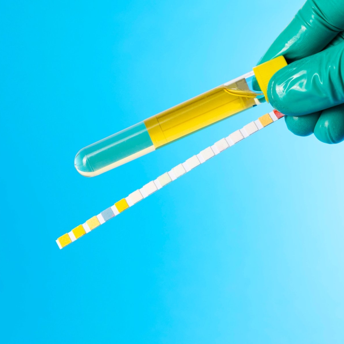 Cristale amorfe în urină: ce înseamnă și de ce apar