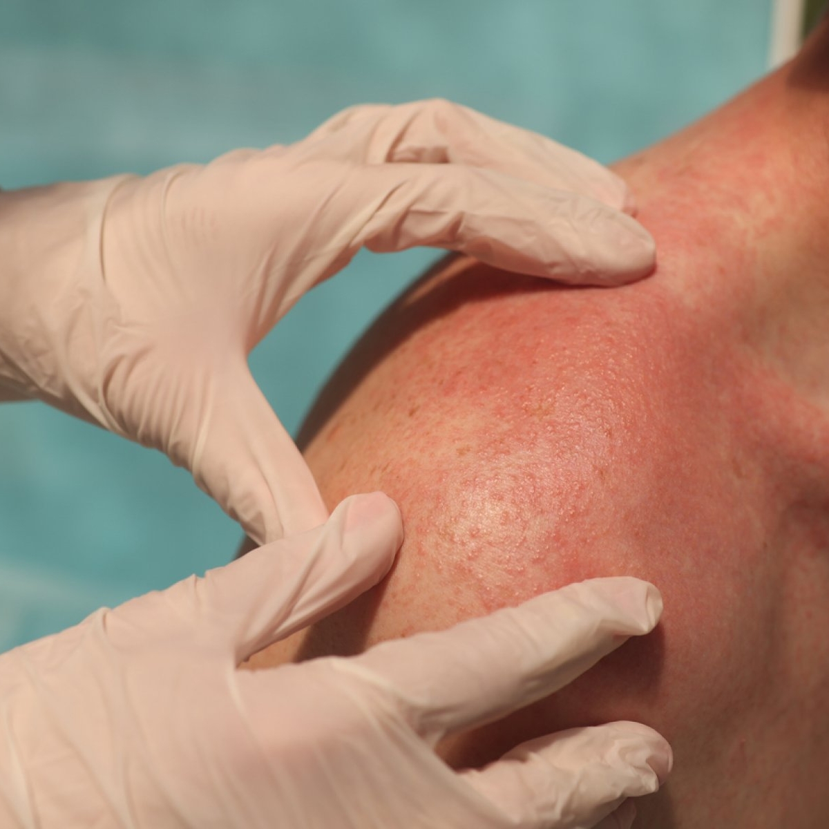 Boala serului: cauze, simptome și tratament