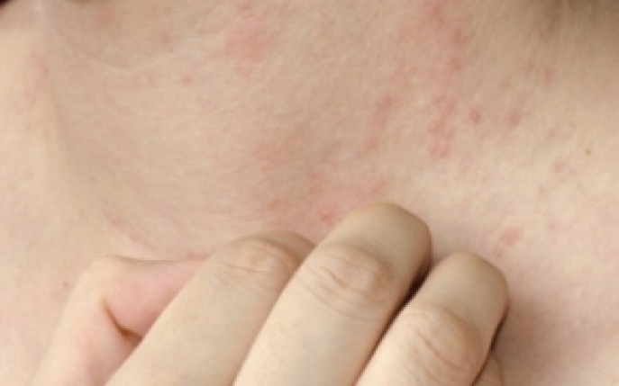 Alergia La Frig Cauze Simptome Tratament