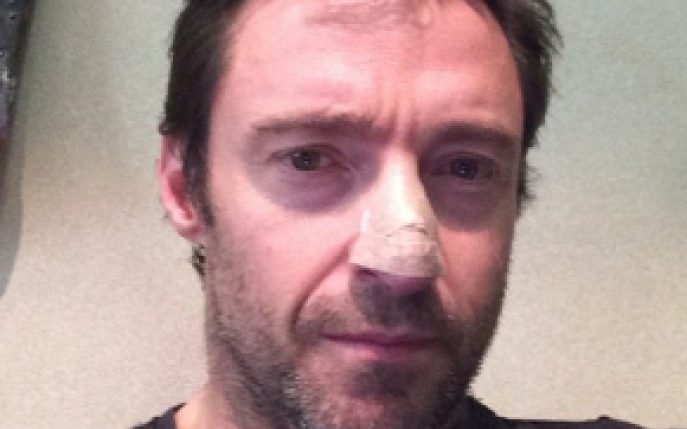 Actorul Hugh Jackman are cancer de piele