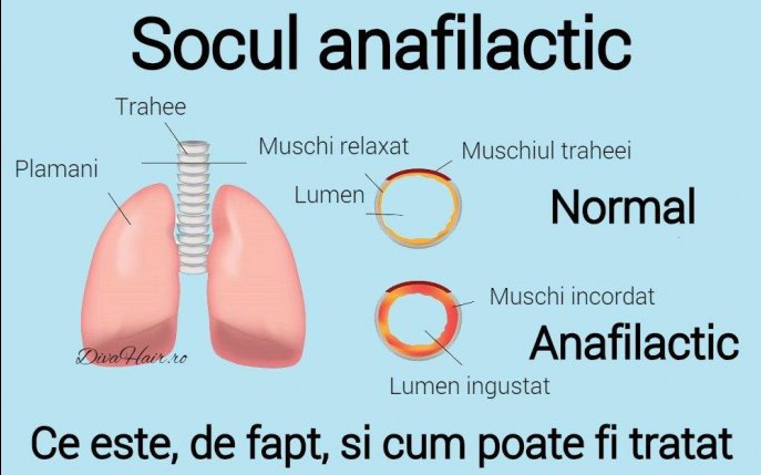 Socul anafilactic: Cauze, simptome si tratament