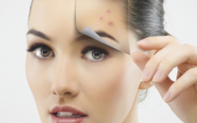 Harta acneei: ce dezvaluie cosurile despre starea ta de sanatate