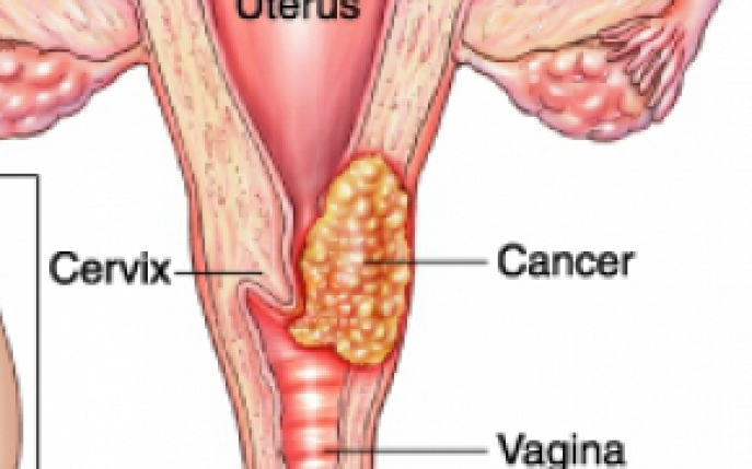 Cancerul de col uterin, mai frecvent in Romania, Bulgaria, Serbia si Lituania. Care sunt CAUZELE