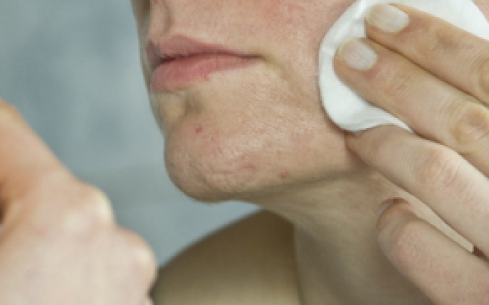Cum sa scapi de cicatricele lasate de acnee: iata 6 remedii naturiste! 