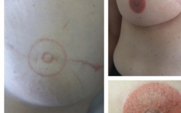 10 femei din Romania vor beneficia gratuit de reconstructia areolei sau a mamelonului prin tehnica micropigmentarii oncologice