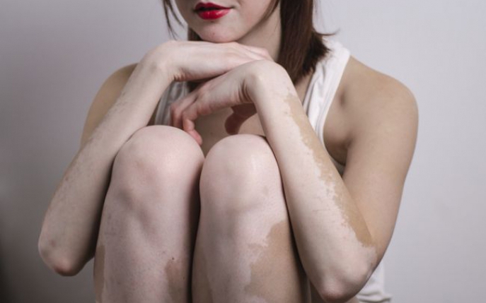 Află ce tratament există pentru vitiligo!