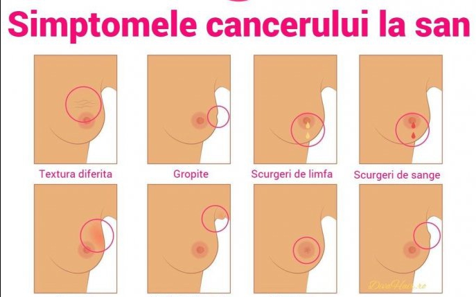 5 semne timpurii de cancer la sân