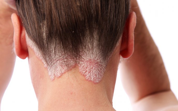Psoriazis scalp: cauze, simptome și tratament