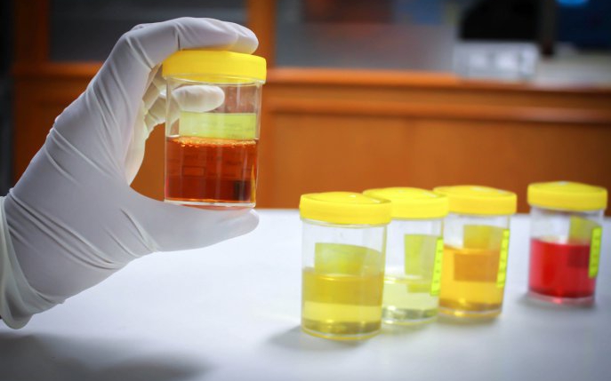 Leucocite în urină: cauze, simptome și tratament