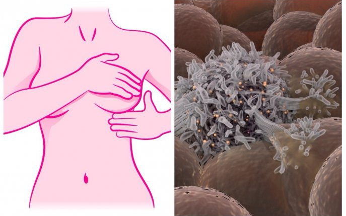 Greșeala zilnică ce te îmbolnăvește de cancer la sân