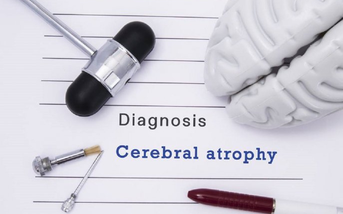 Atrofia cerebrală: cauze, simptome, tratament