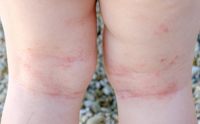 mâncărimea pielii picioarelor în varicoză