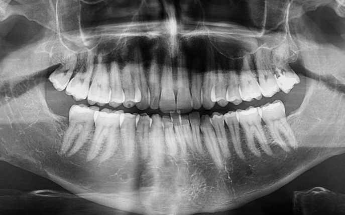 Cât de periculoase sunt radiografiile dentare