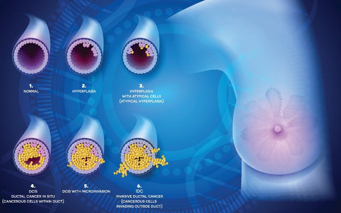 Carcinom ductal invaziv: cauze, simptome și tratament